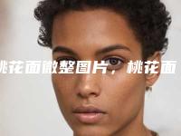 桃花面微整图片，桃花面微整的是什么原理？